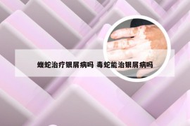 蝮蛇治疗银屑病吗 毒蛇能治银屑病吗