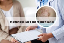 银屑病的外用药膏无激素 银屑病外涂药膏