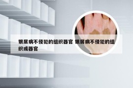 银屑病不侵犯的组织器官 银屑病不侵犯的组织或器官