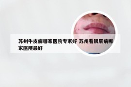 苏州牛皮癣哪家医院专家好 苏州看银屑病哪家医院最好