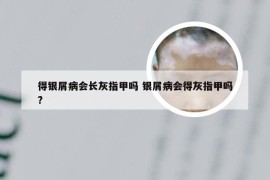 得银屑病会长灰指甲吗 银屑病会得灰指甲吗?