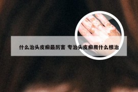 什么治头皮癣最厉害 专治头皮癣用什么根治