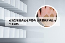 点滴型银屑病能吃洋葱吗 点滴型银屑病能吃牛羊肉吗