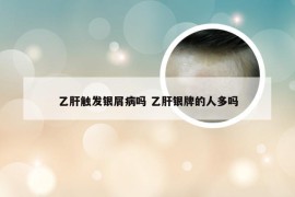 乙肝触发银屑病吗 乙肝银牌的人多吗