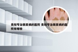 贵阳专治银屑病的医院 贵阳专治银屑病的医院有哪些