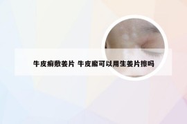 牛皮癣敷姜片 牛皮廨可以用生姜片擦吗