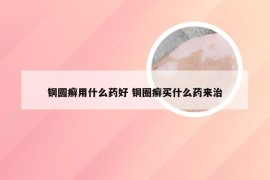 铜圆癣用什么药好 铜圈癣买什么药来治