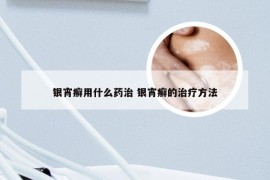 银宵癣用什么药治 银宵癣的治疗方法