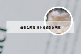 癣怎么回事 腿上长癣怎么回事