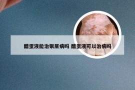 醋蛋液能治银屑病吗 醋蛋液可以治病吗