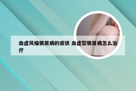 血虚风燥银屑病的症状 血虚型银屑病怎么治疗