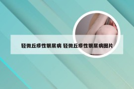 轻微丘疹性银屑病 轻微丘疹性银屑病图片