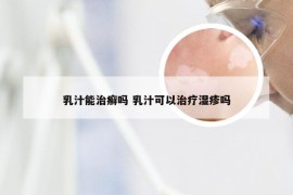 乳汁能治癣吗 乳汁可以治疗湿疹吗