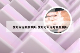 艾叶水治银屑病吗 艾叶可以治疗银屑病吗