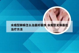 水疱型脚癣怎么治最好最快 水疱型足癣最佳治疗方法