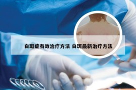 白斑症有效治疗方法 白斑最新治疗方法