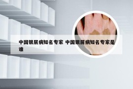 中国银屑病知名专家 中国银屑病知名专家是谁