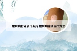 银屑病打点滴什么药 银屑病输液治疗方法