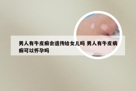 男人有牛皮癣会遗传给女儿吗 男人有牛皮病癣可以怀孕吗