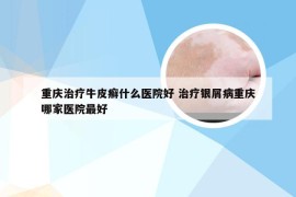 重庆治疗牛皮癣什么医院好 治疗银屑病重庆哪家医院最好