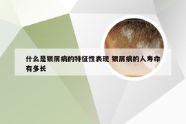 什么是银屑病的特征性表现 银屑病的人寿命有多长