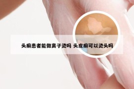 头癣患者能做离子烫吗 头皮癣可以烫头吗