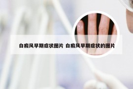 白瘕风早期症状图片 白瘕风早期症状的图片