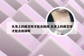 头发上的癣怎样才能去除掉 头发上的癣怎样才能去除掉呢