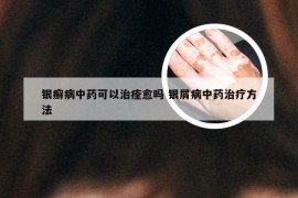 银癣病中药可以治痊愈吗 银屑病中药治疗方法