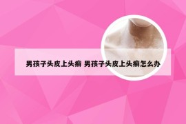 男孩子头皮上头癣 男孩子头皮上头癣怎么办