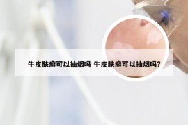 牛皮肤癣可以抽烟吗 牛皮肤癣可以抽烟吗?