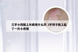 三岁小孩腿上长癣用什么药 3岁孩子腿上起了一片小疙瘩