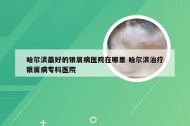 哈尔滨最好的银屑病医院在哪里 哈尔滨治疗银屑病专科医院