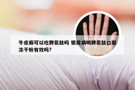 牛皮癣可以吃脾氨肽吗 银屑病喝脾氨肽口服冻干粉有效吗?