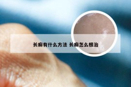 长癣有什么方法 长癣怎么根治