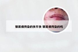 银屑病传染的快不快 银屑病传染的吗