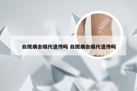 白斑病会隔代遗传吗 白斑病会隔代遗传吗