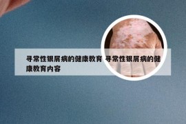 寻常性银屑病的健康教育 寻常性银屑病的健康教育内容