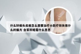 什么轩癣头皮癣怎么需要治疗小款疗效快用什么的偏方 合家欢睦是什么意思