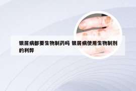 银屑病都要生物制药吗 银屑病使用生物制剂的利弊