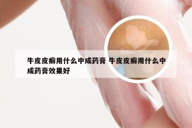 牛皮皮癣用什么中成药膏 牛皮皮癣用什么中成药膏效果好