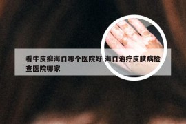 看牛皮癣海口哪个医院好 海口治疗皮肤病检查医院哪家