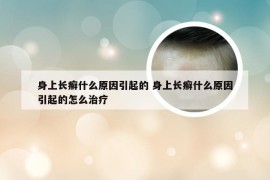 身上长癣什么原因引起的 身上长癣什么原因引起的怎么治疗