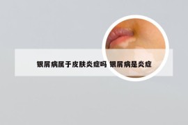 银屑病属于皮肤炎症吗 银屑病是炎症