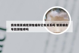 我有银屑病现颈椎痛和它有关系吗 银屑病会导致颈椎疼吗