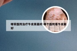 哪家医院治疗牛皮屑最好 哪个医院看牛皮廨好