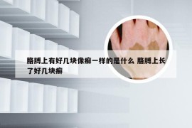 胳膊上有好几块像癣一样的是什么 胳膊上长了好几块癣