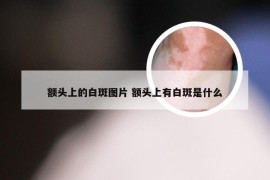 额头上的白斑图片 额头上有白斑是什么