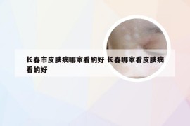 长春市皮肤病哪家看的好 长春哪家看皮肤病看的好