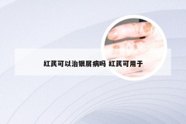 红芪可以治银屑病吗 红芪可用于